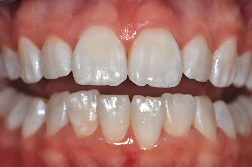 dents jaunes pendant traitement - exemple 1