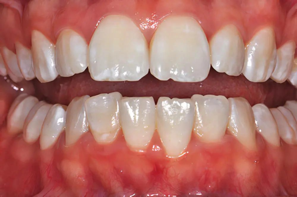 dents blanchies final - exemple 1