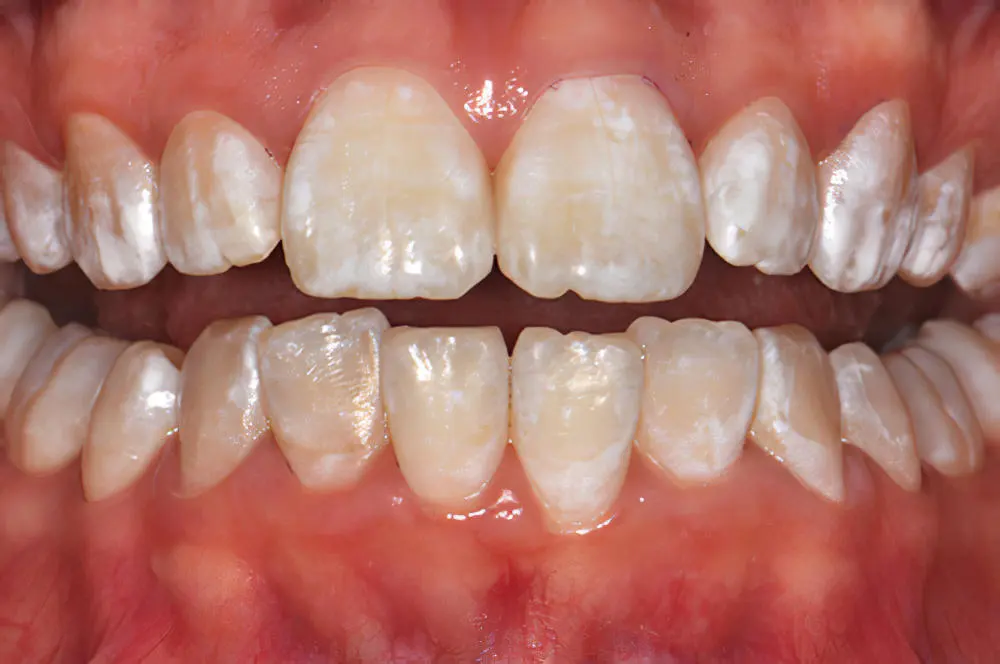 dent jaunes avant traitement - exemple 1