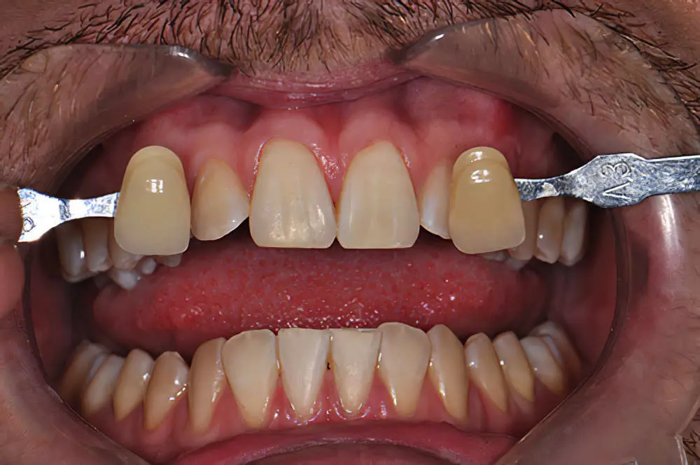 blanchiment dentaire traitement