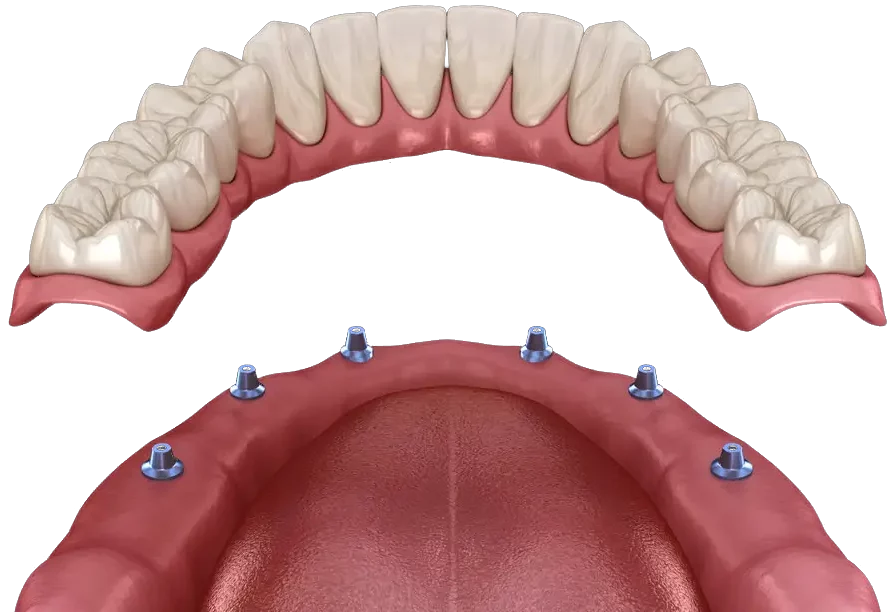 prothèse dentaire fixe