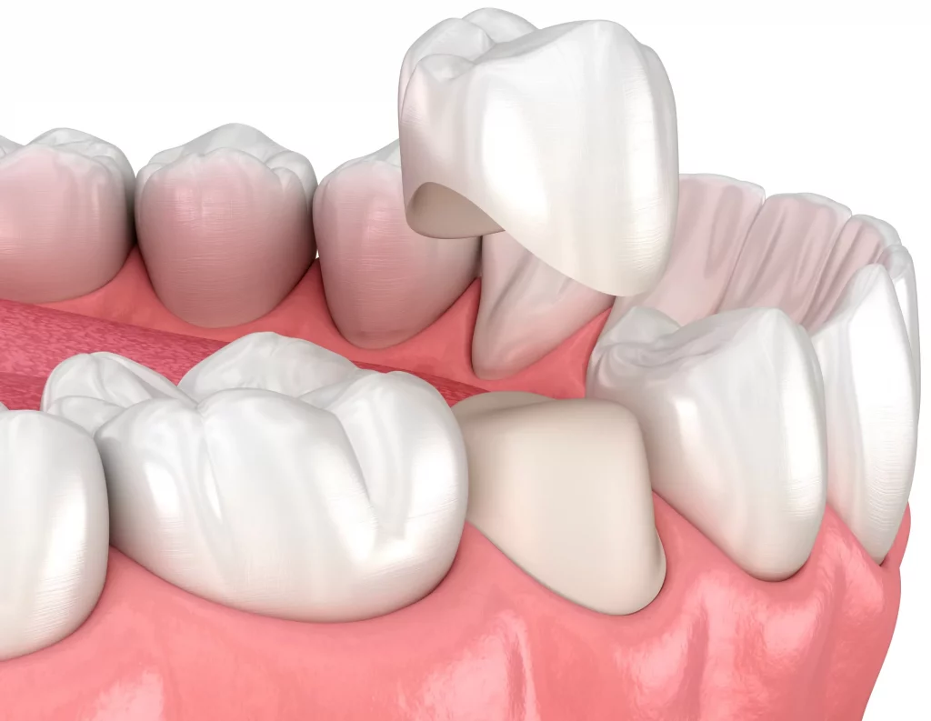 couronne dentaire