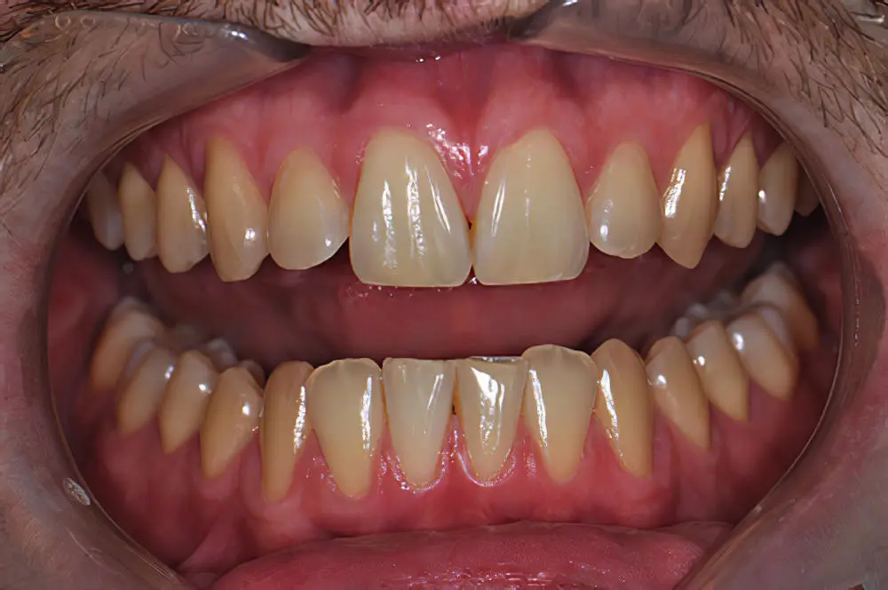 blanchiment dentaire état initial