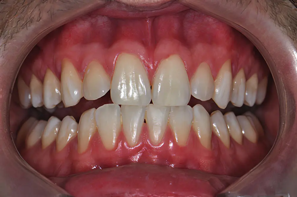 blanchiment dentaire état final