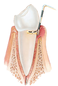 schéma début de parodontite