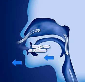 schéma solution au ronflement avec orhtèse dentaire
